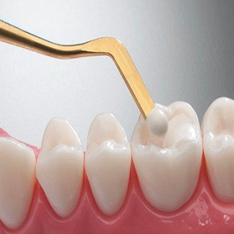 62dbf5c948e948432db68795_FATETE-DENTARE-SAU-OBTURATII-DIN-COMPOZIT
