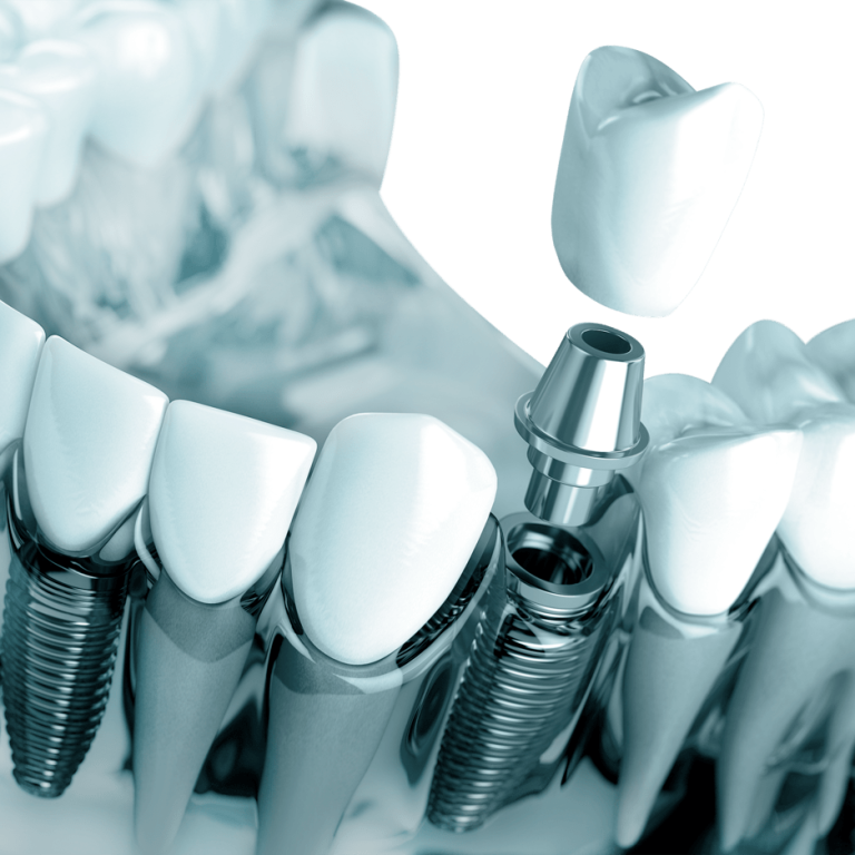 tooth-implant-in-the-model-human-teeth-gums-and-d-2021-08-26-16-56-57-utc